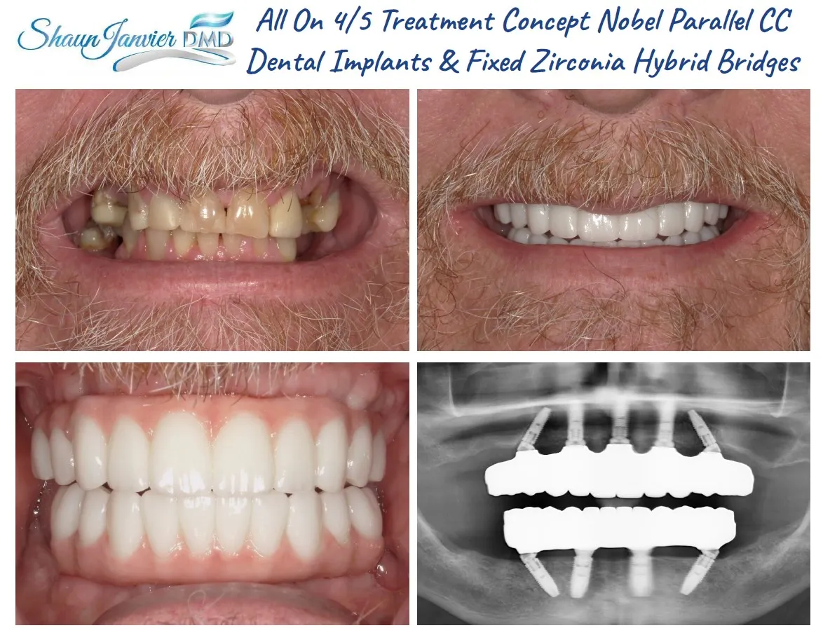 All on 4 Full Mouth Implants