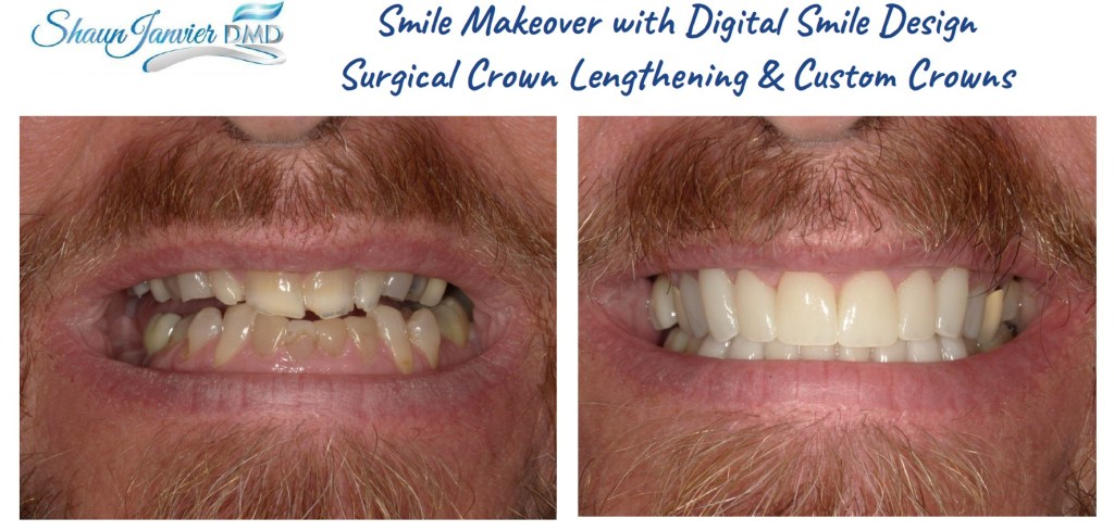 Smile Design Crowns with Crown Lengthening